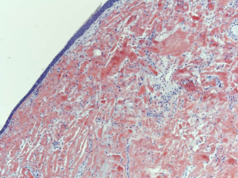 Congo red stain showing dense amorphous extracellular material consistent with amyloid