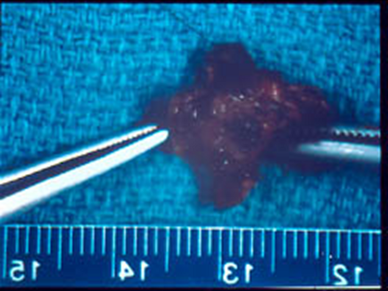 Laser Resection Specimen