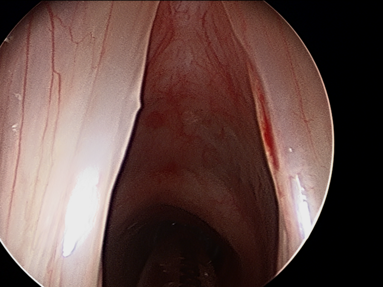 Intraop Microdirect Laryngoscopy with Resection