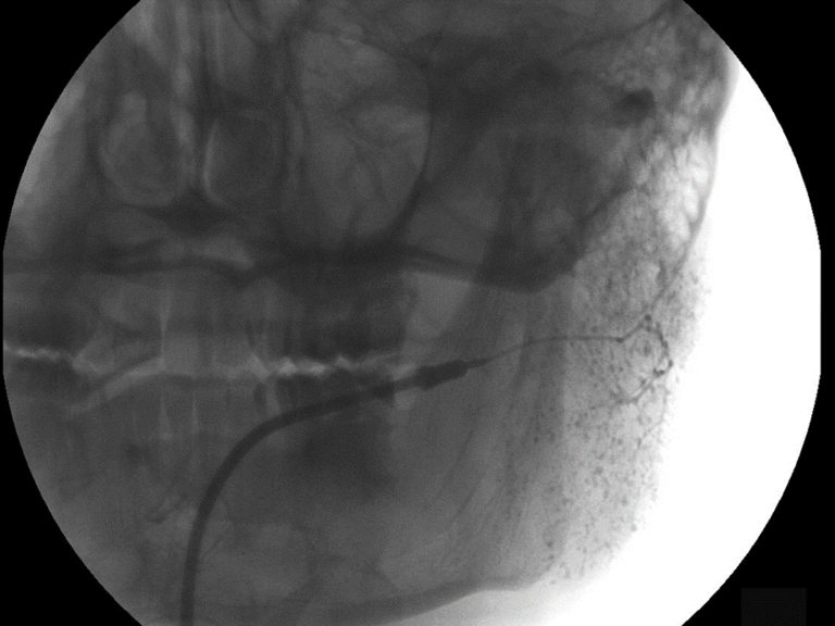 AP films offering alternate perspective of left gland filled with 3 cc Isovue 370