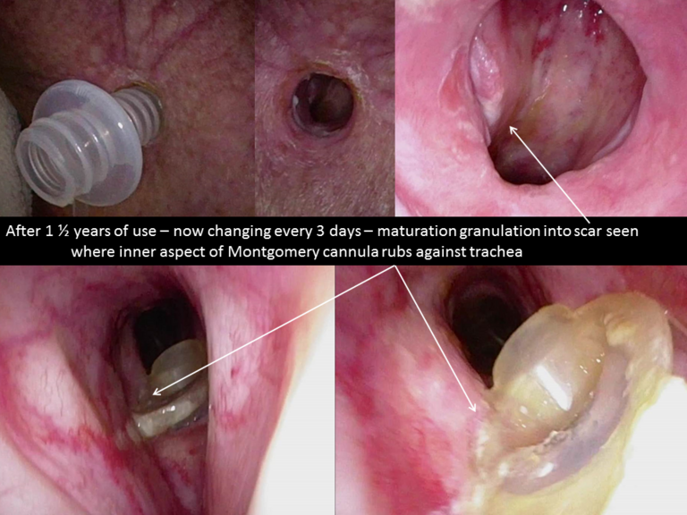 Frequent (every third day) changes decreases acute irritation but mature scar forms