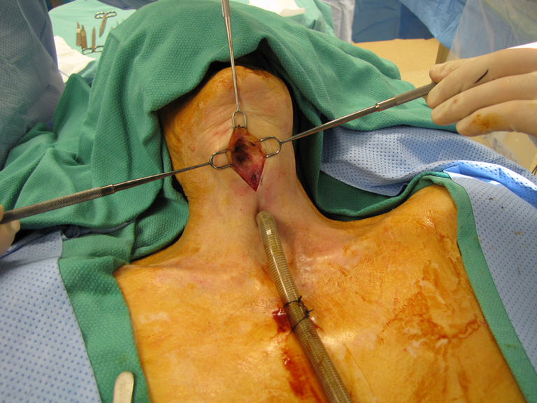 Near-Field Laryngectomy Sequence