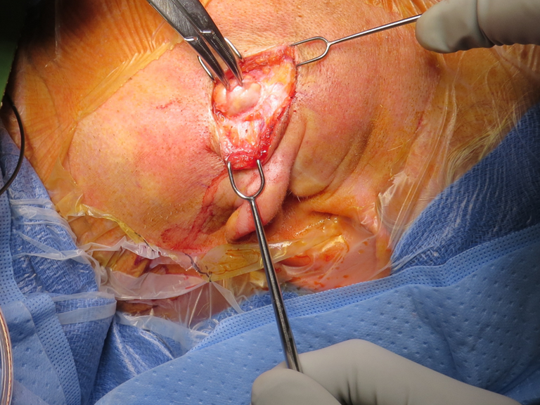 Lymphadenoma parotid