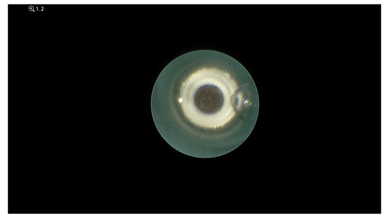 laser sialendoscopy for parotid stone