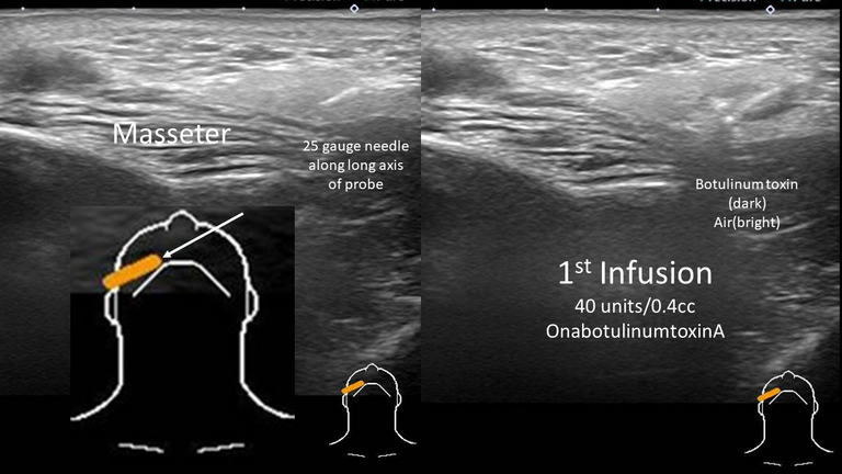 Botox® for sialadenitis after parotidectomy