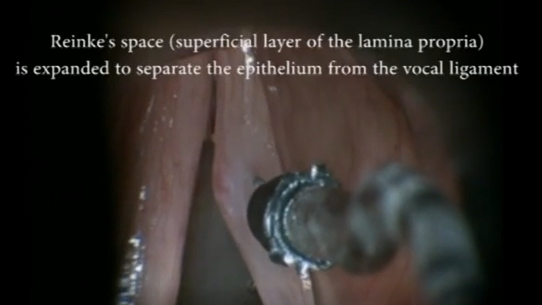 Resection vocal cord lesion with suture orientation