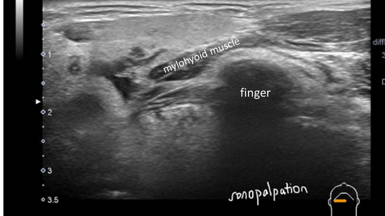 stone not seen on CT US or sialogram