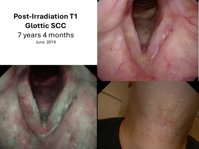 T1 post XRT long term sequence