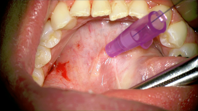 SMG cannulation with Prolene and 26 gauge angio