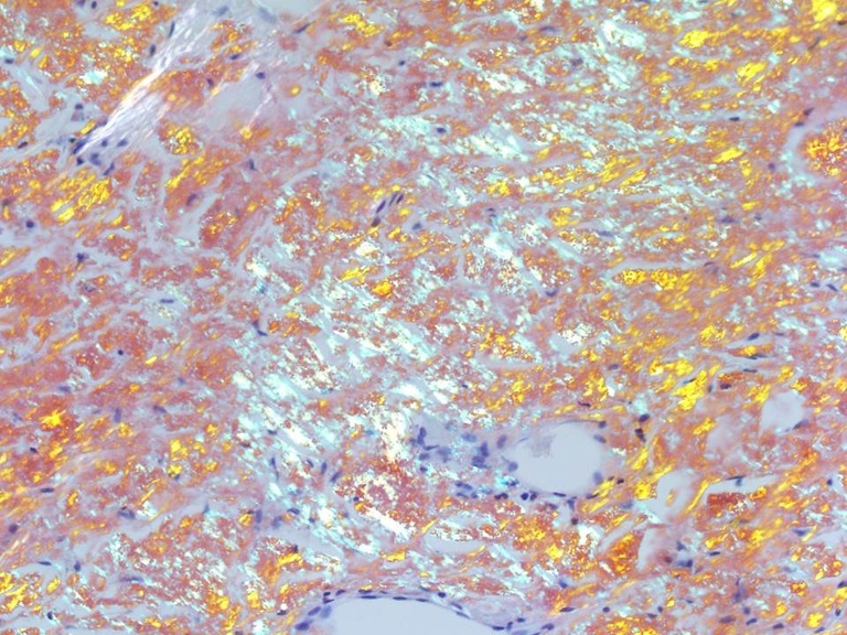 Apple green birefringence under polarized light pathognomonic for amyloid