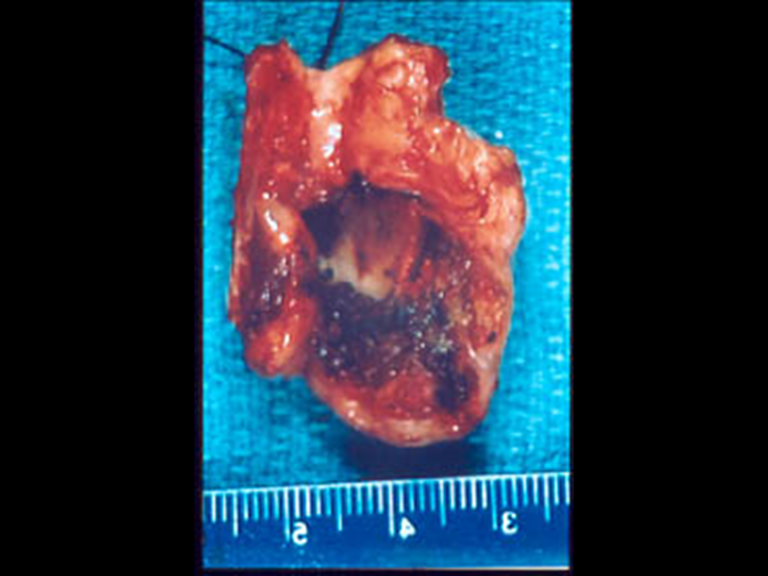 Conversion to open vertical partial laryngectomy (specimen)