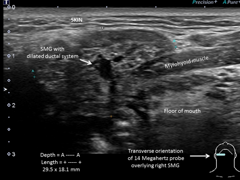 Labelled ultrasound transverse image of right submandibular gland