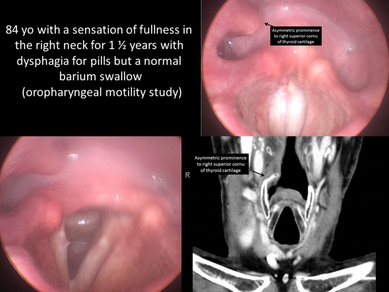 asymmetric prominence to right superior cornu of thyroid