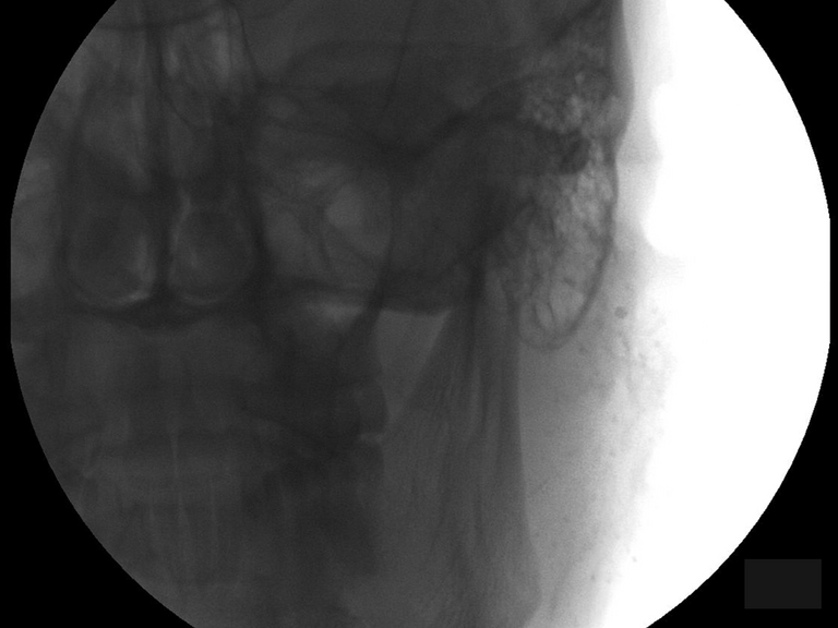 AP view after administration of lemon drops, oral rinse and spit showing partial clearing