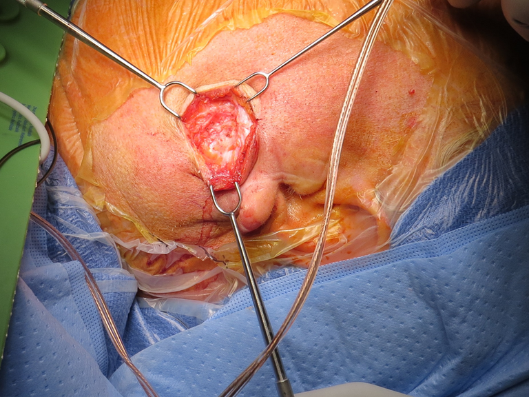 Lymphadenoma parotid