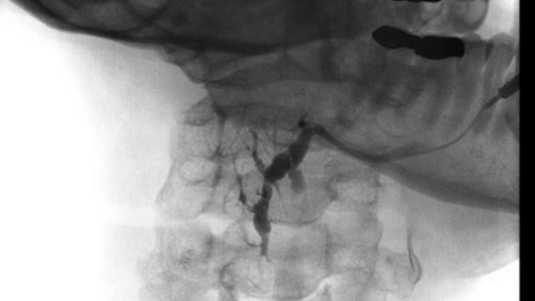ultrasound and sialogram correlates of submandibular duct obstruction