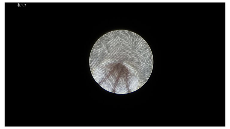 laser sialendoscopy for parotid stone