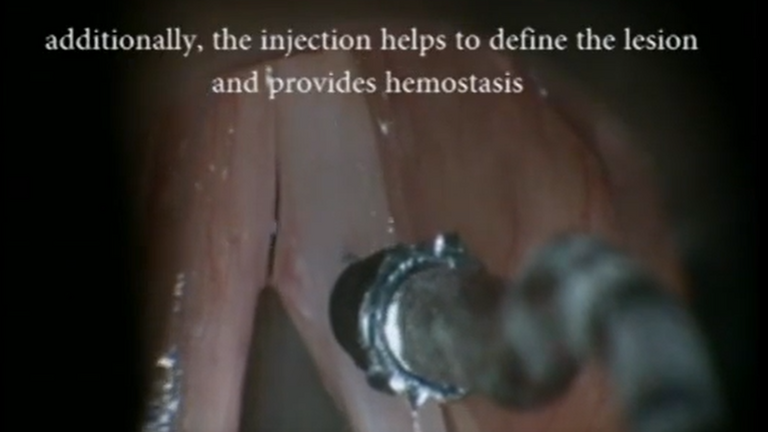 Resection vocal cord lesion with suture orientation