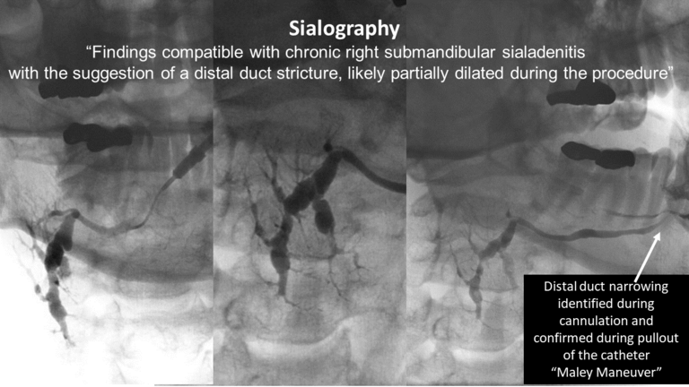 stone not seen on CT US or sialogram