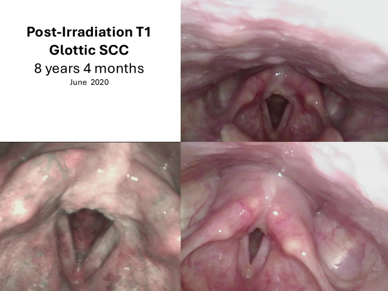 T1 post XRT long term sequence