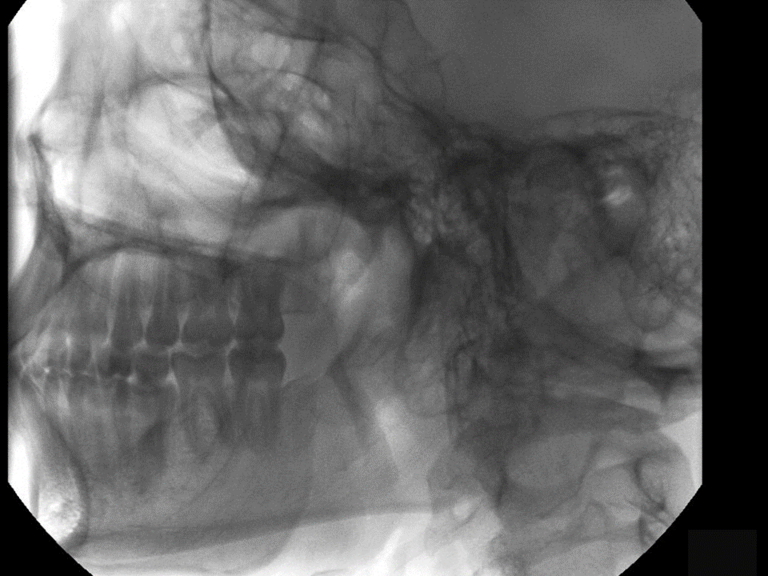 Lateral view after administration of lemon drops, oral rinse and spit showing partial clearing