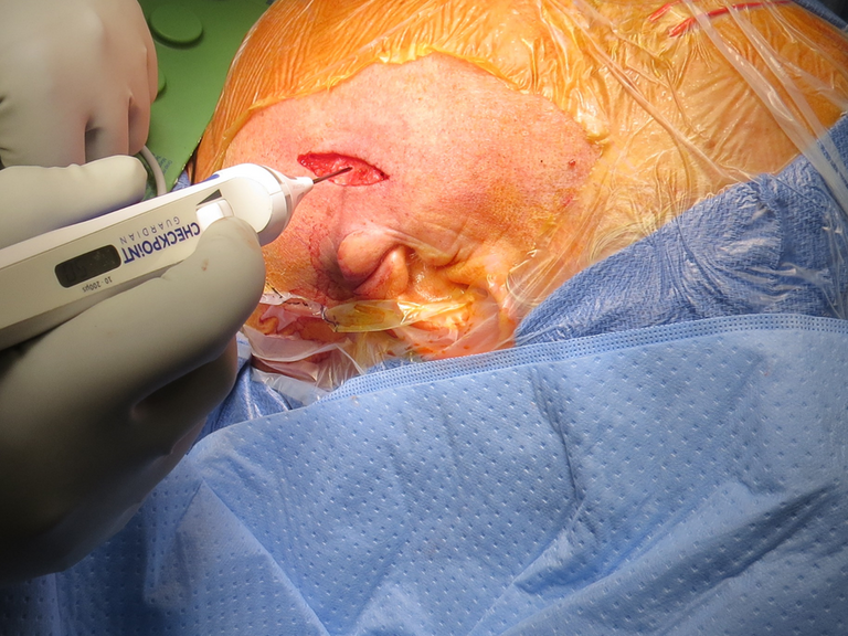 Lymphadenoma parotid