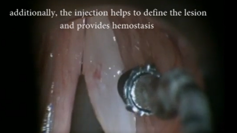 Resection vocal cord lesion with suture orientation