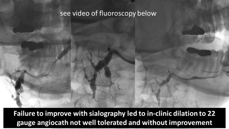 stone not seen on CT US or sialogram