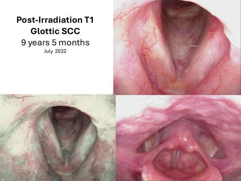 T1 post XRT long term sequence