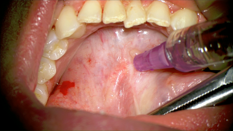 SMG cannulation with Prolene and 26 gauge angio