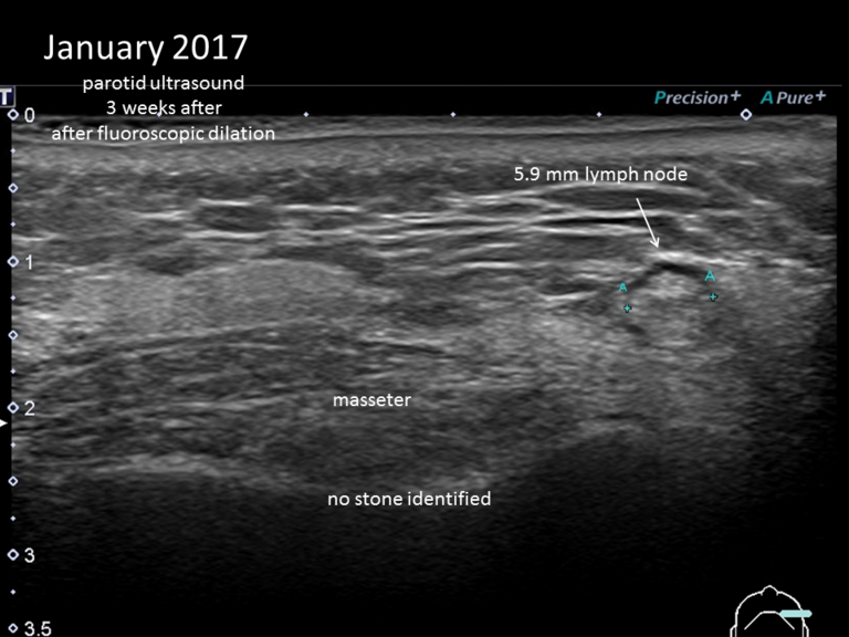 January 2017 Ultrasound done three weeks after fluoroscopy for repeat dilation in clinic