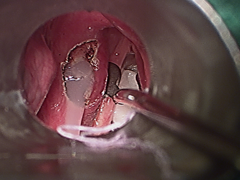 Intraop