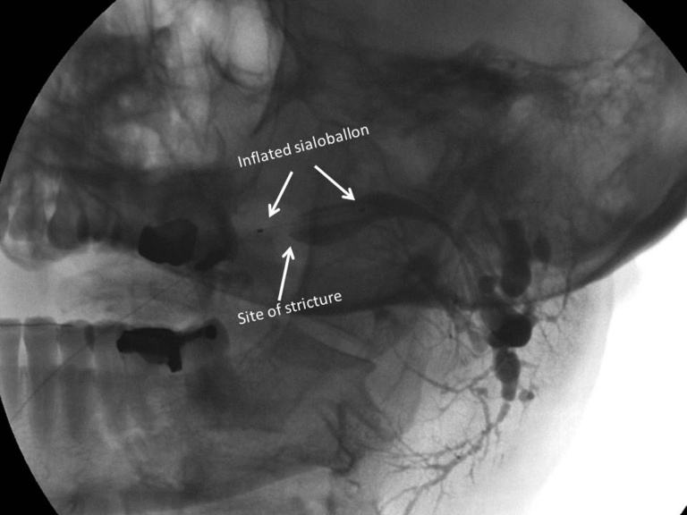 B Sialoballon inflated after contrast infusion left parotid duct