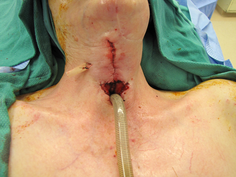 Near-Field Laryngectomy Sequence
