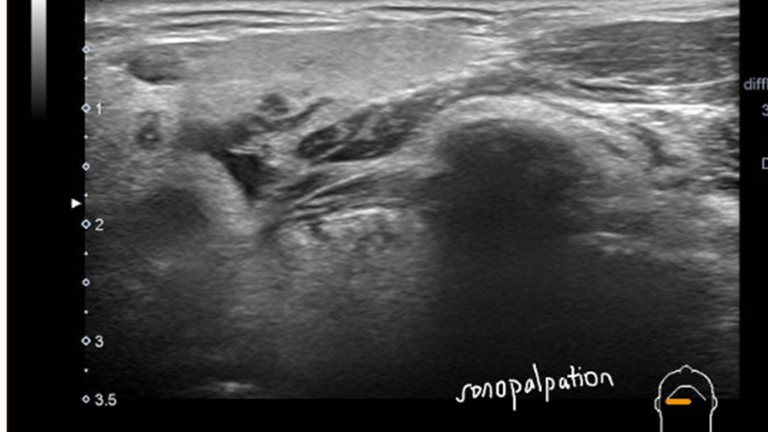 ultrasound and sialogram correlates of submandibular duct obstruction