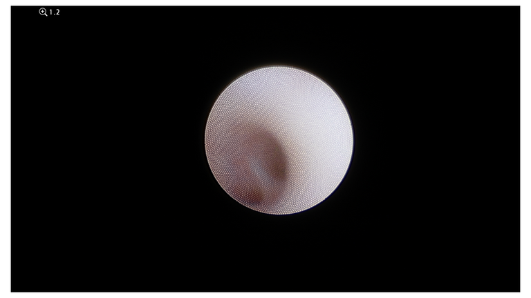 laser sialendoscopy for parotid stone