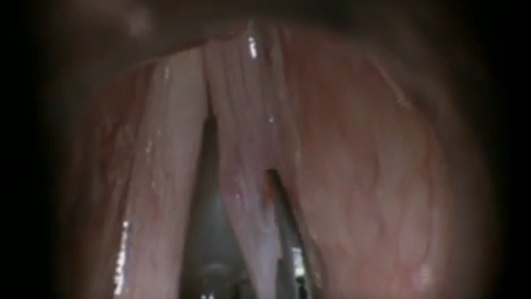 Resection vocal cord lesion with suture orientation
