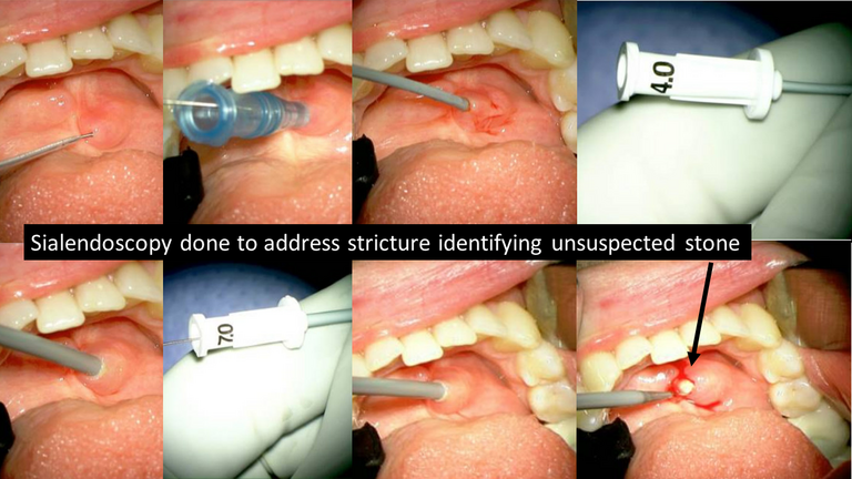 stone not seen on CT US or sialogram