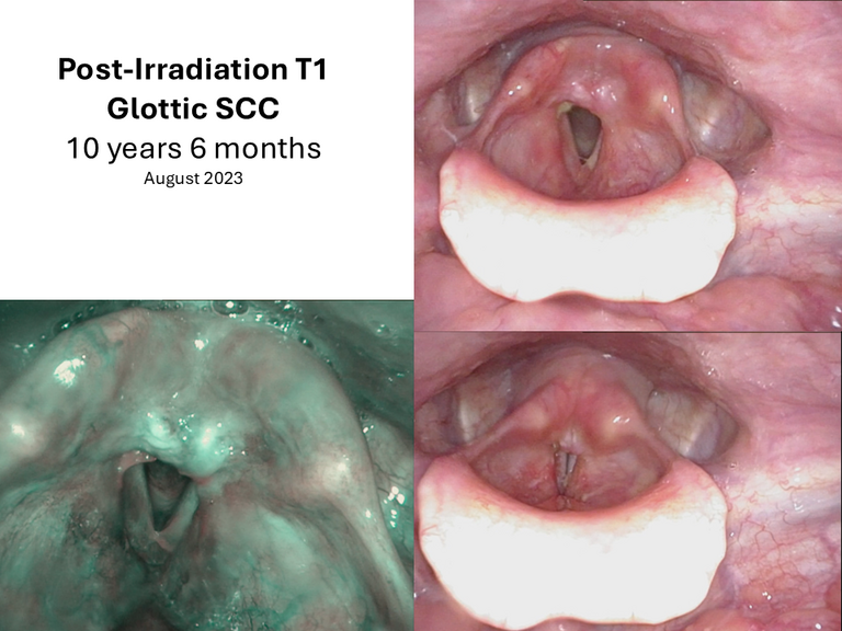 T1 post XRT long term sequence