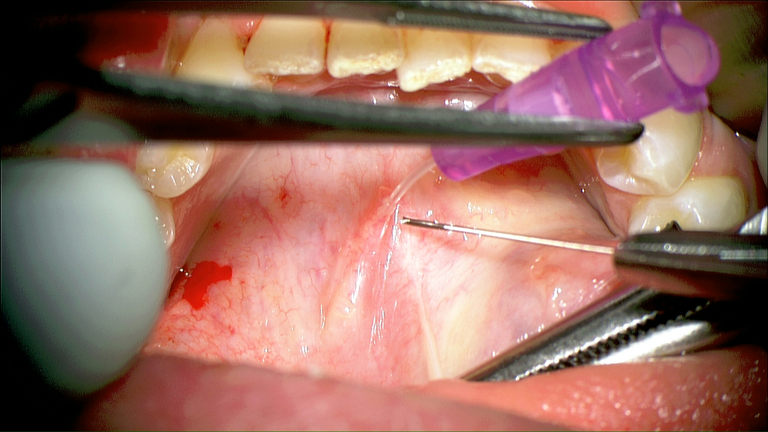 SMG cannulation with Prolene and 26 gauge angio