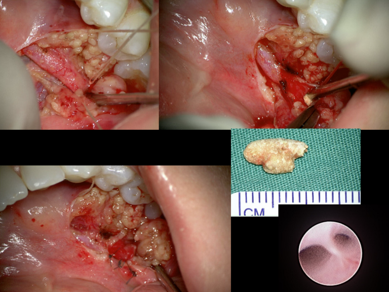Open approach to duct shows stricture anterior to duct treated with open ductoplasty