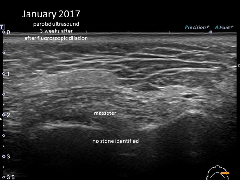 January 2017 ultrasound in clinic shows no discernible stone