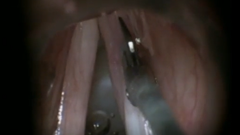 Resection vocal cord lesion with suture orientation