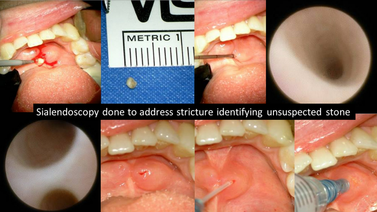stone not seen on CT US or sialogram