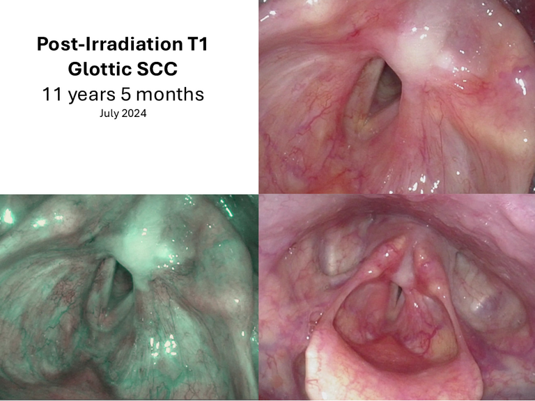 T1 post XRT long term sequence