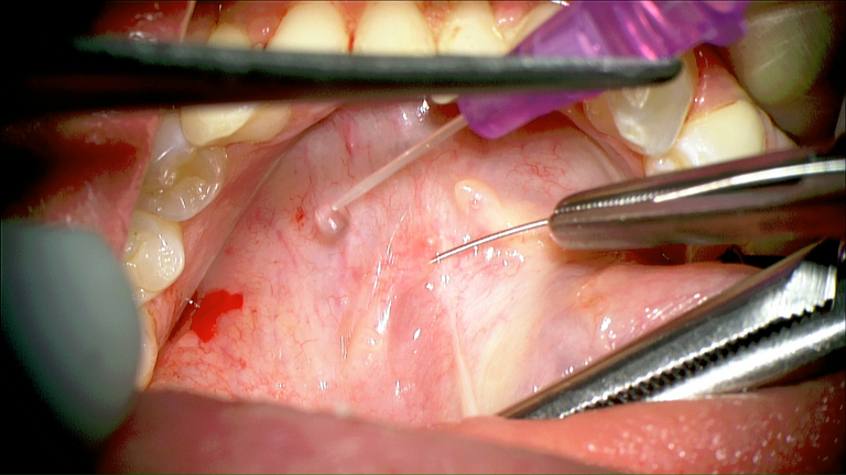 SMG cannulation with Prolene and 26 gauge angio