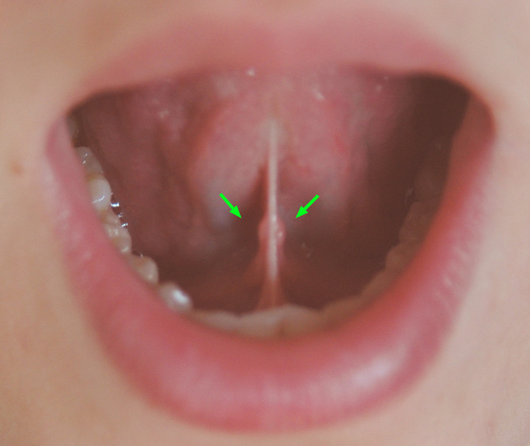 Sublingual Caruncula and orifice adjacent to the frenulum (Created by and used with permission from Hellerhoff)