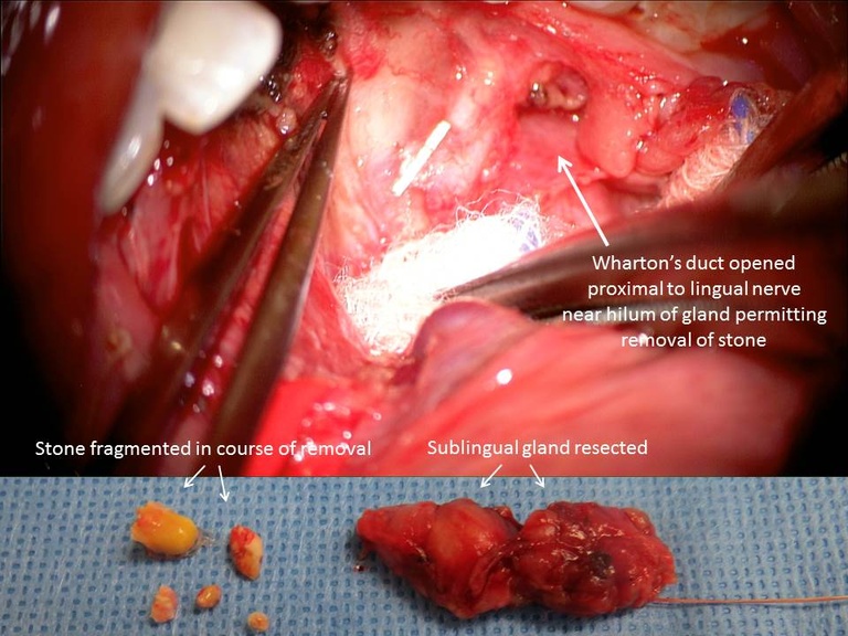 Submandibular duct scarring Conaway.jpg
