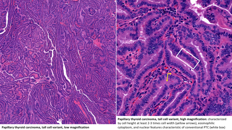 Papillary thyroid carcinoma, tall cell variant, low magnification (left) and high magnification (right).