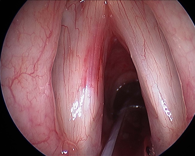 after cyst excision.jpg